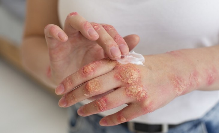 Argentina registra un fuerte repunte de sífilis y enciende alertas sanitarias