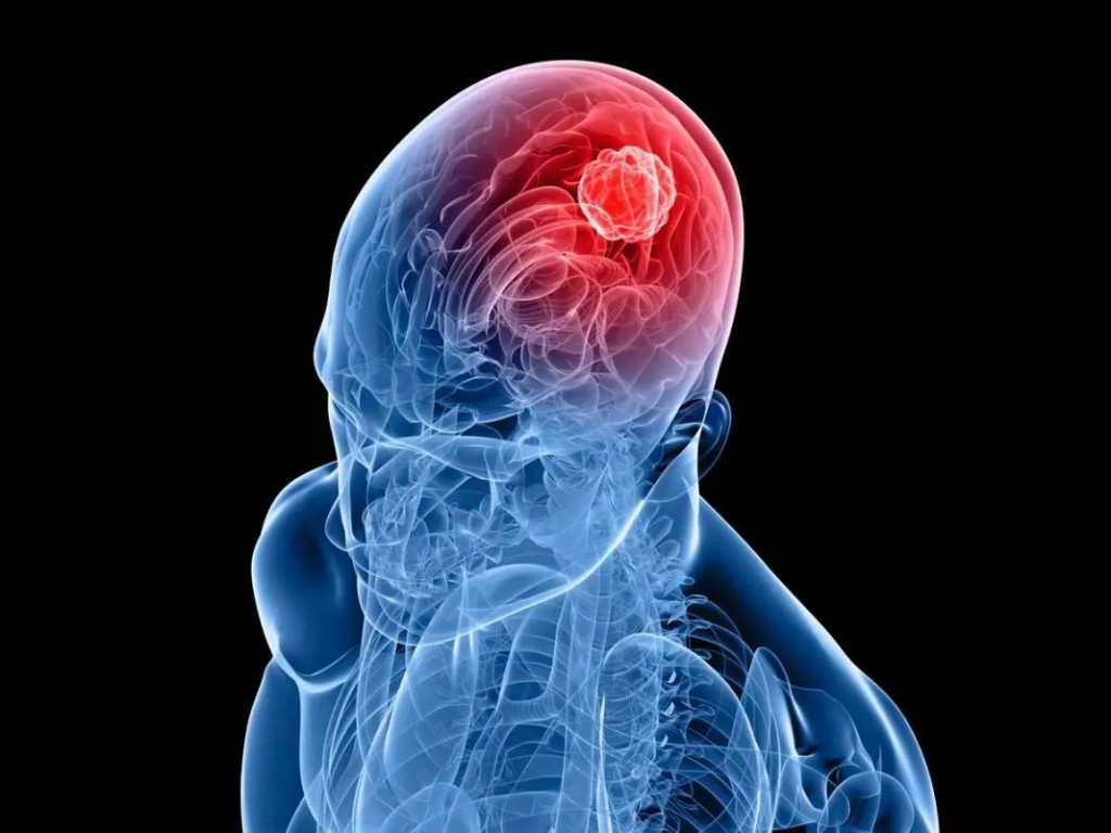 Investigación de CONICET logra frenar un tipo de cáncer cerebral
